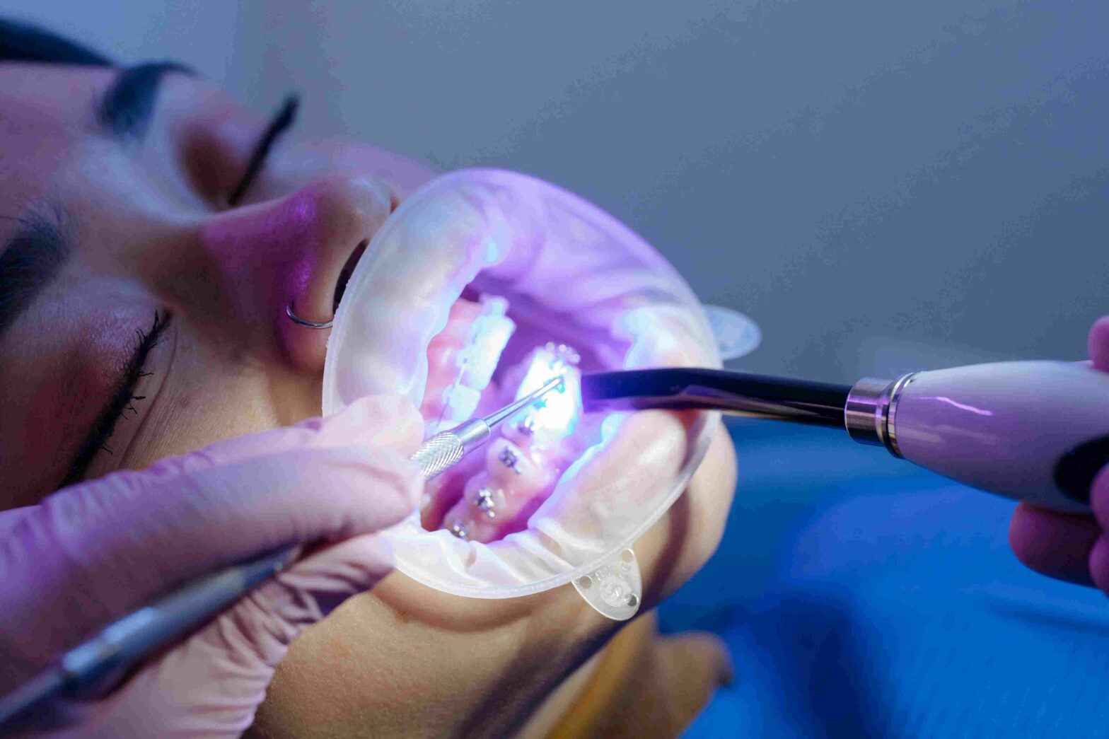 3D Printed Braces 2025