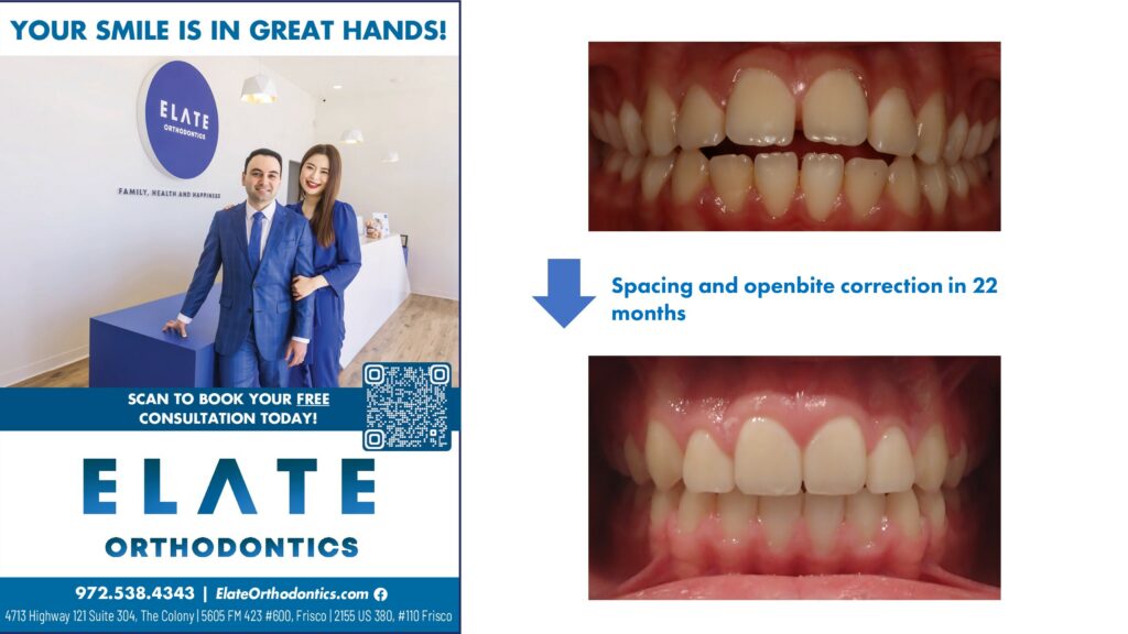 Spacing correction by the best Invisalign dentist in Frisco TX 2025