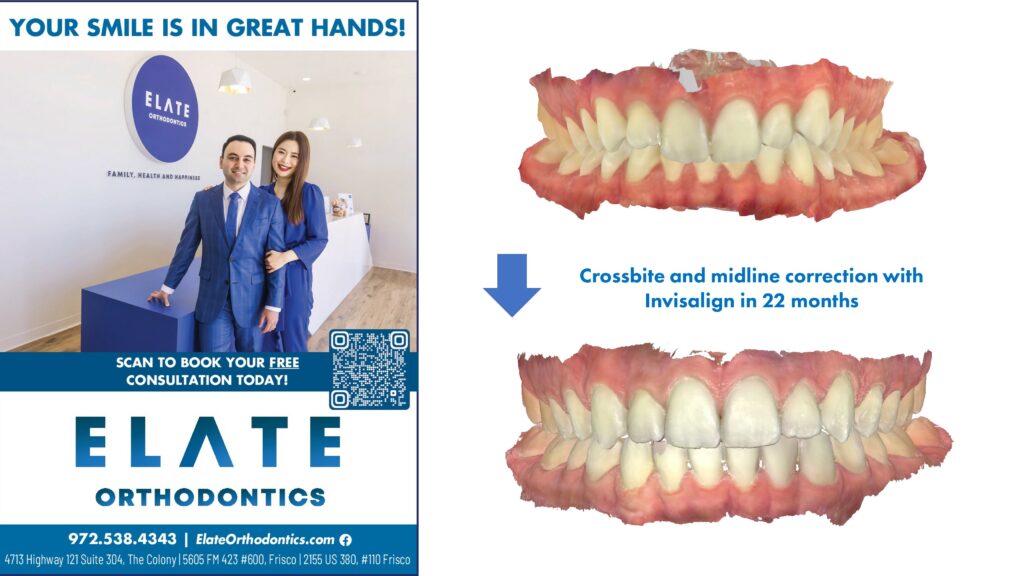 Crossbite and midline correction by the best Invisalign dentist in Frisco TX 2025