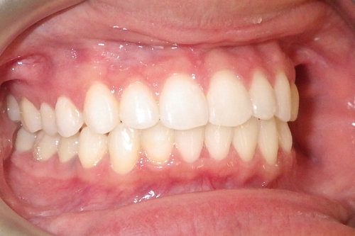 Image showing a properly aligned bite with upper teeth slightly overlapping the lowers and molars fitting together correctly.
