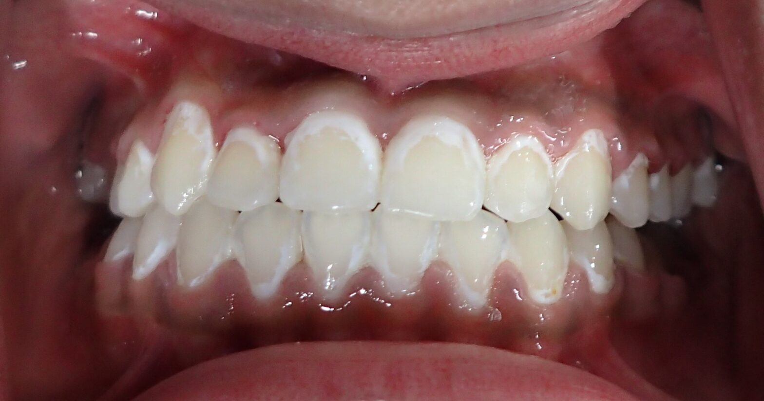 White spot lesions on teeth from not brushing during braces treatment Frisco TX