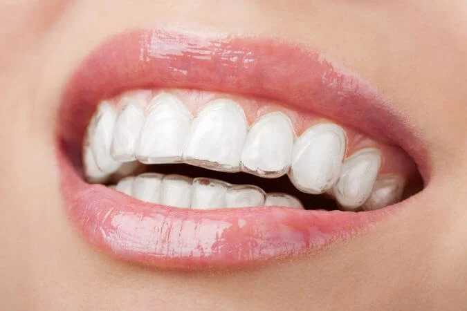 Teen wearing Invisalign in Frisco tx under treatment with Elate Orthodontics - top Frisco provider