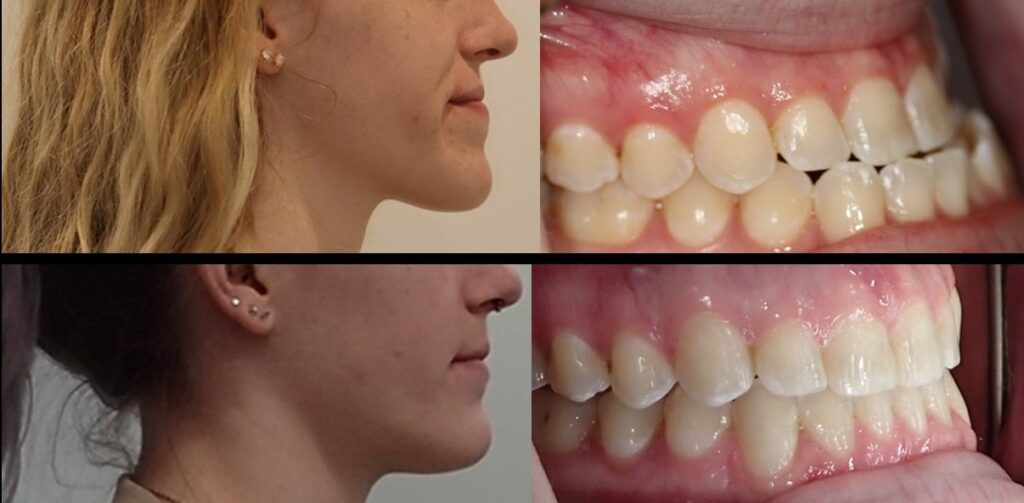 before and after of a patient treated with clear aligner and jaw surgery at Elate Orthodontics
