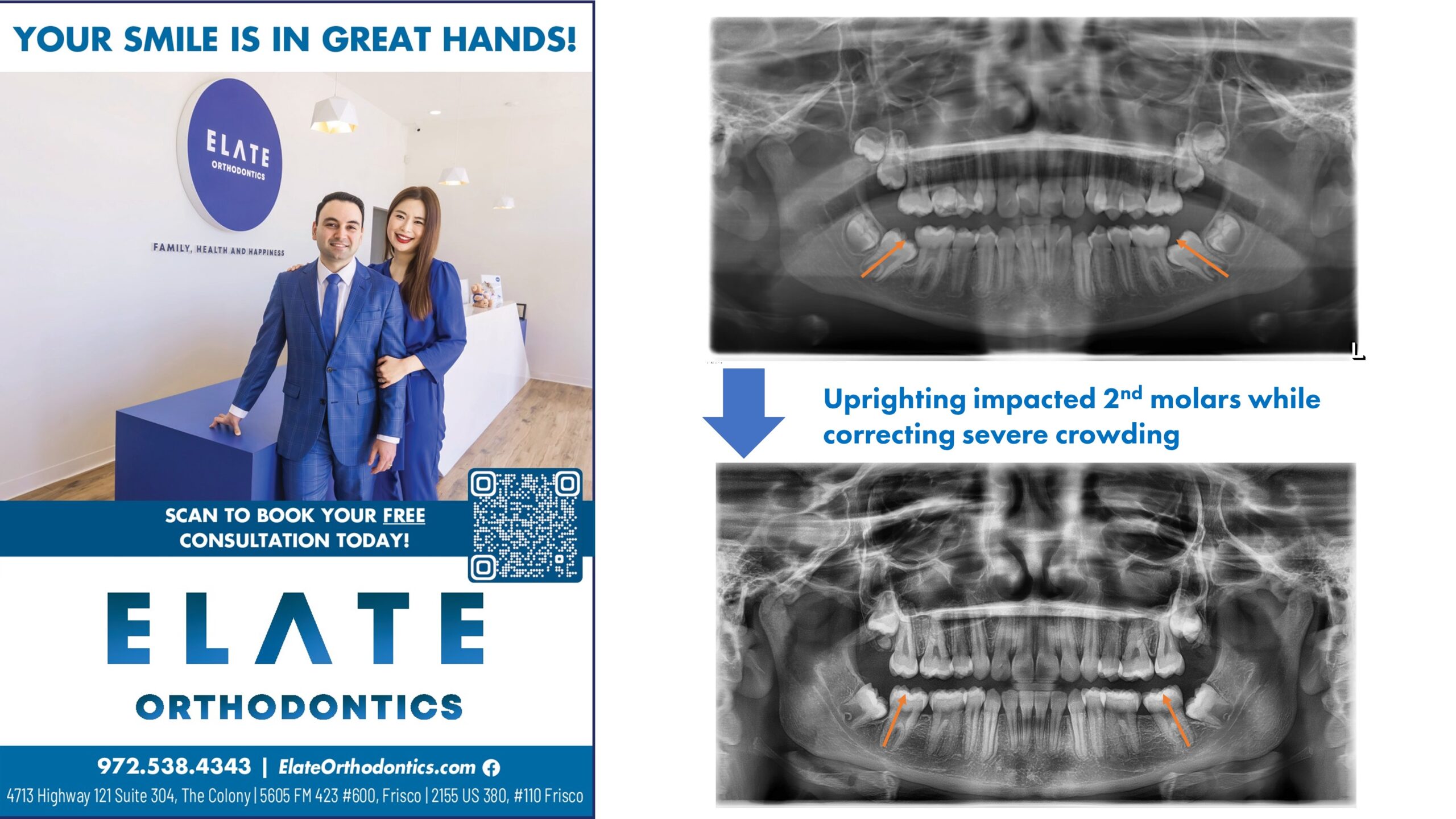 Impacted second molar uprighting case at Elate Orthodontics Frisco TX - before and after panoramic X-ray