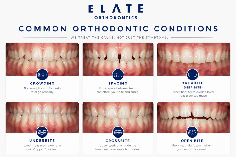 Orthodontic conditions we treat at Elate Orthodontics Frisco TX including overbite underbite crossbite crowding and impacted teeth