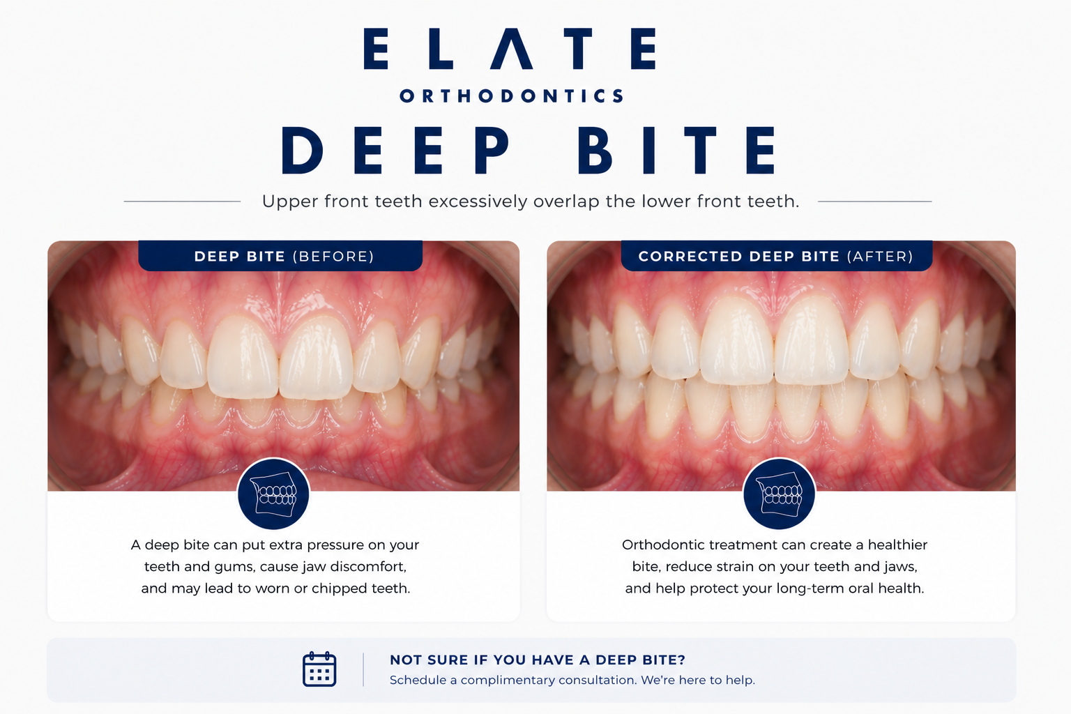 Deep bite correction at Elate Orthodontics in Frisco and The Colony TX with braces clear aligners and bite turbos