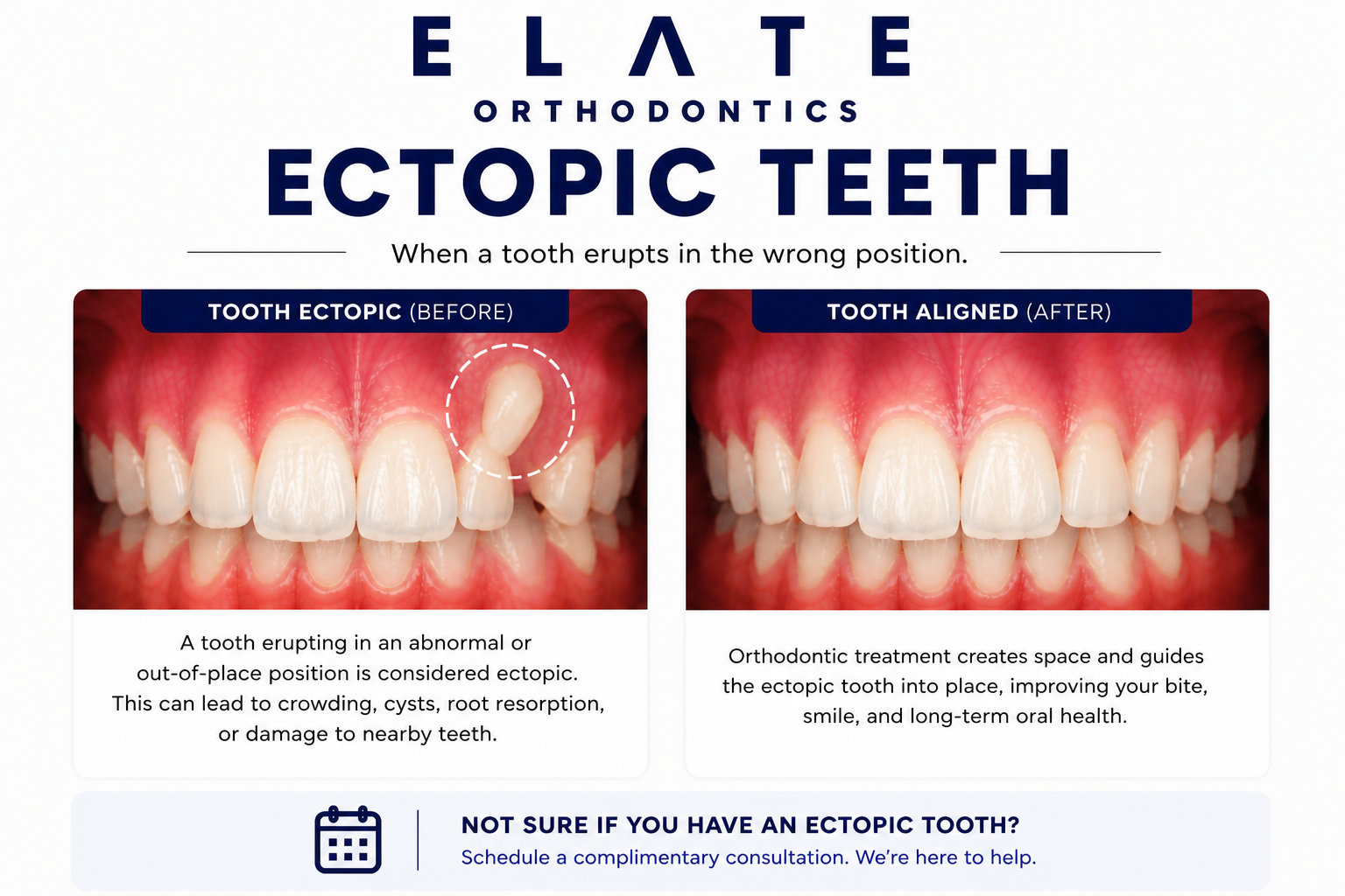 Ectopic eruption correction at Elate Orthodontics in Frisco and The Colony TX with early Phase 1 interceptive treatment and braces