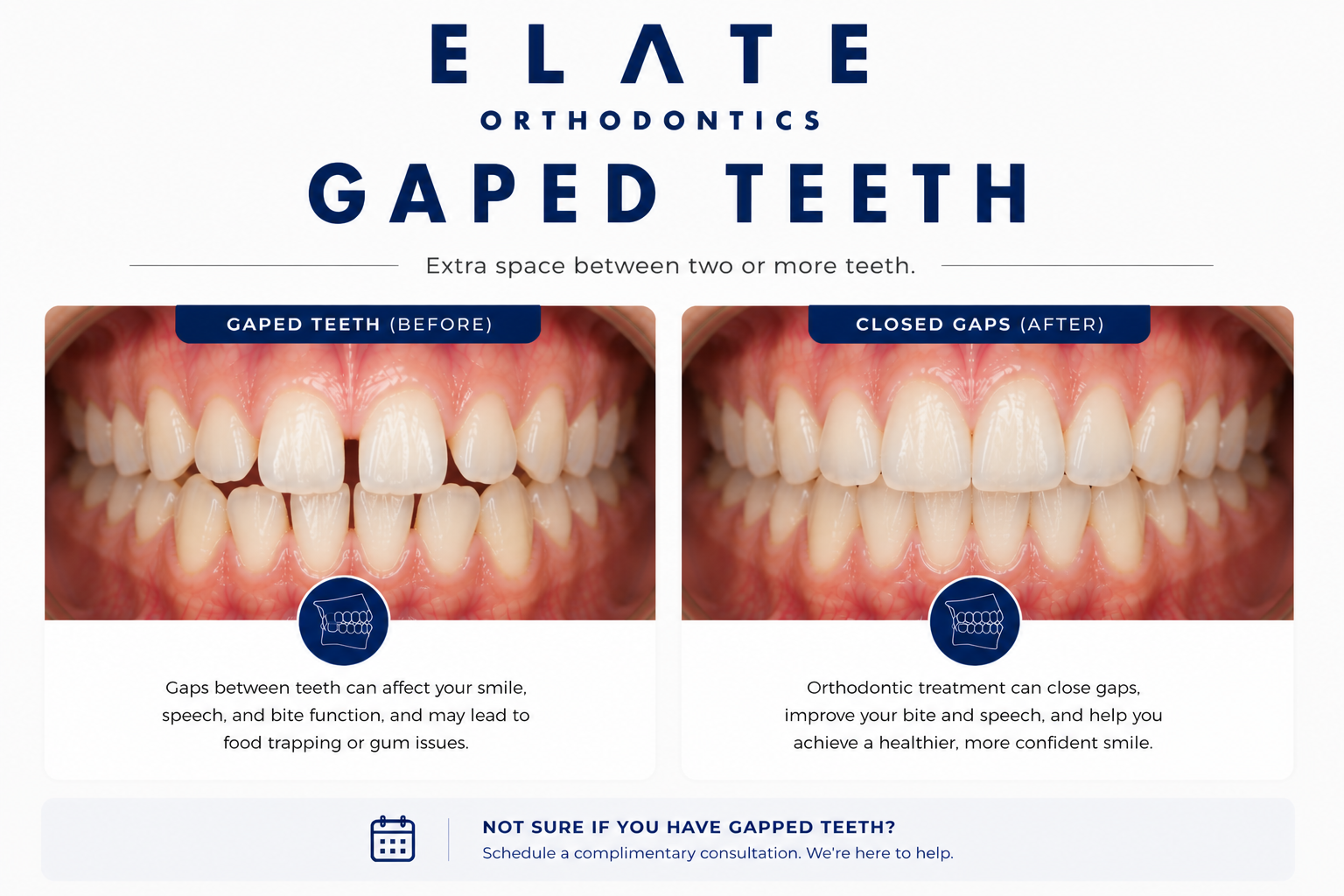 Gapped teeth and diastema closure at Elate Orthodontics in Frisco and The Colony TX with braces and clear aligners