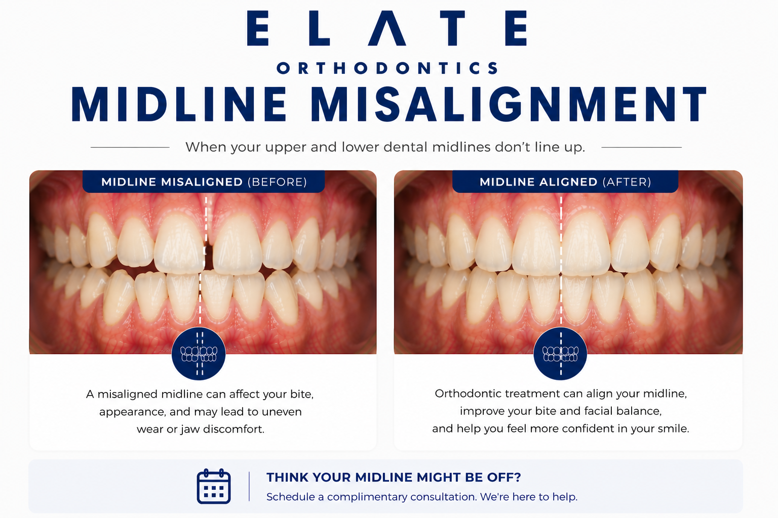 Midline misalignment correction at Elate Orthodontics in Frisco and The Colony TX with braces and clear aligners