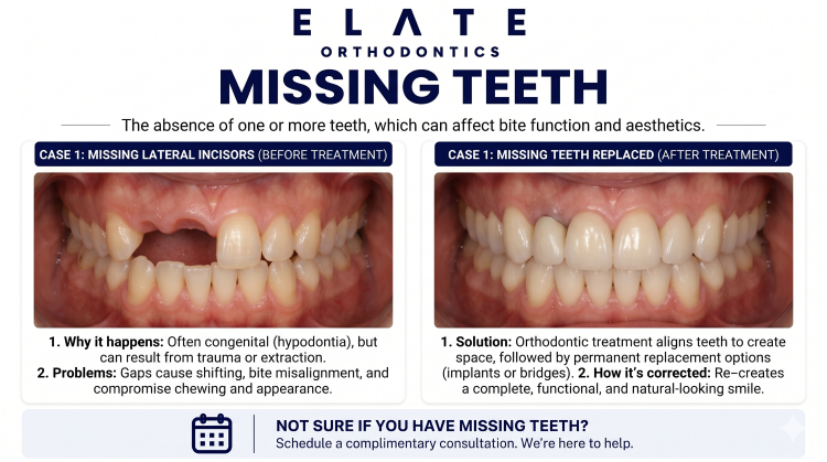 Missing teeth treatment at Elate Orthodontics in Frisco and The Colony TX with space management orthodontics and implant coordination