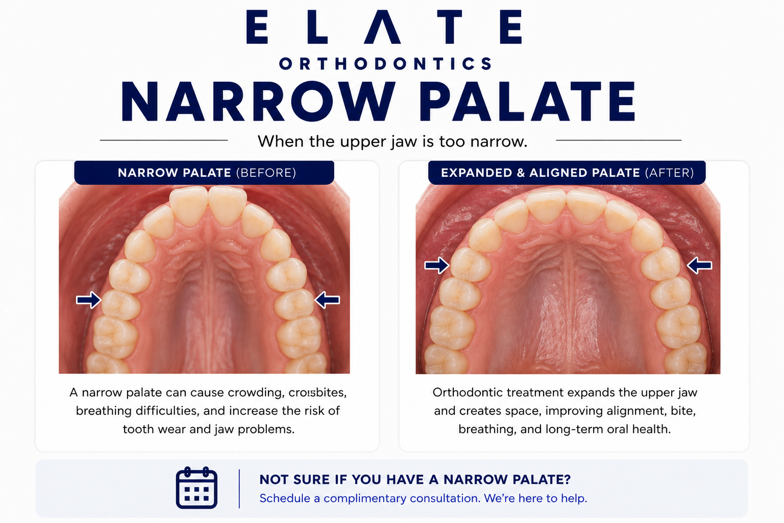 Narrow Palate Treatment Frisco The Colony Orthodontists