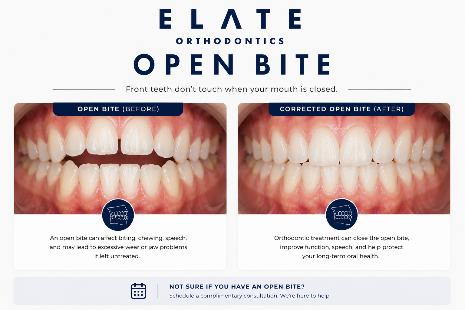 Open bite treatment at Elate Orthodontics in Frisco and The Colony TX with braces clear aligners and habit therapy