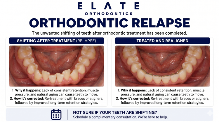 Orthodontic relapse retreatment at Elate Orthodontics in Frisco and The Colony TX with adult braces aligners and permanent retention