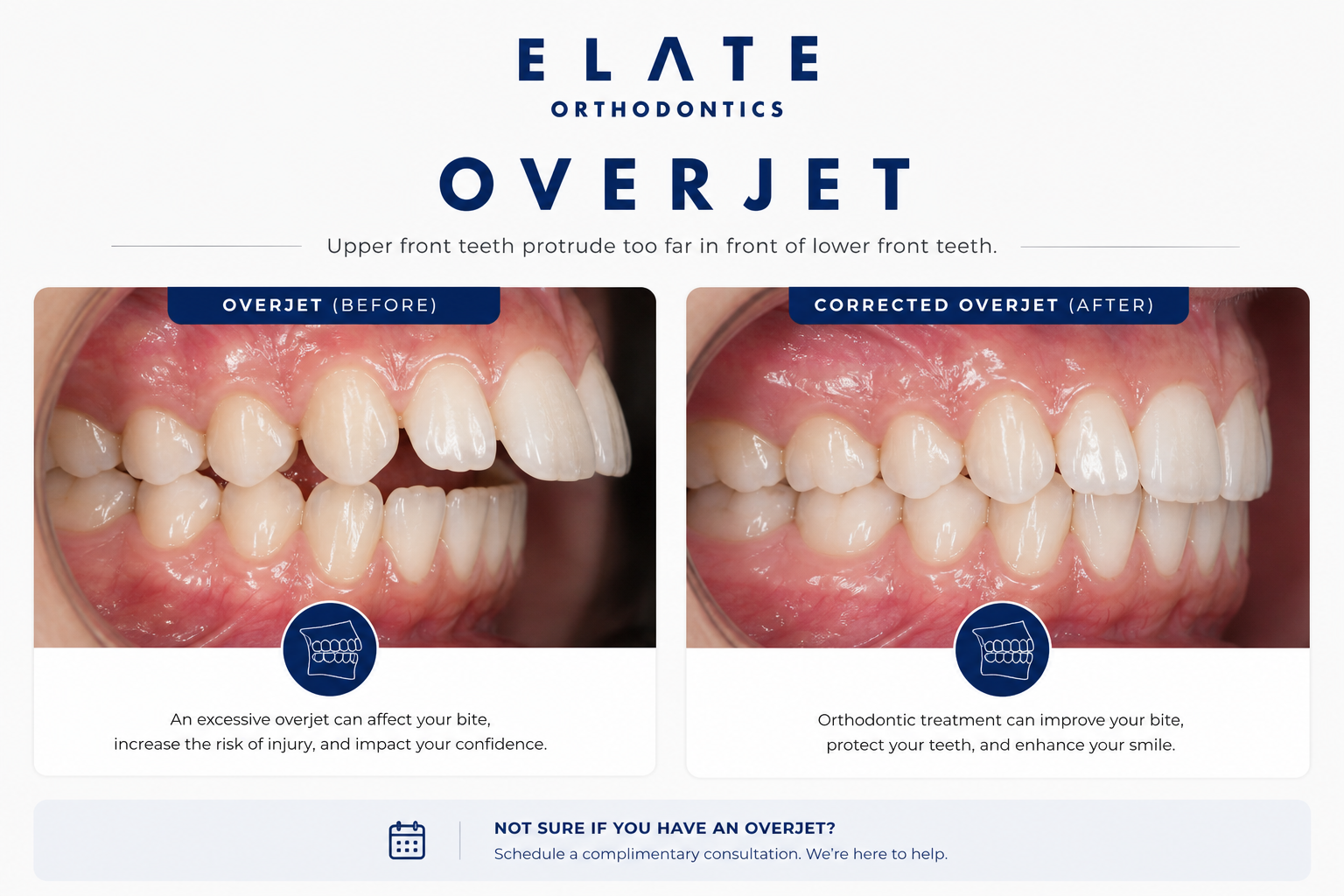 Overbite and overjet correction at Elate Orthodontics in Frisco and The Colony TX with braces and clear aligners