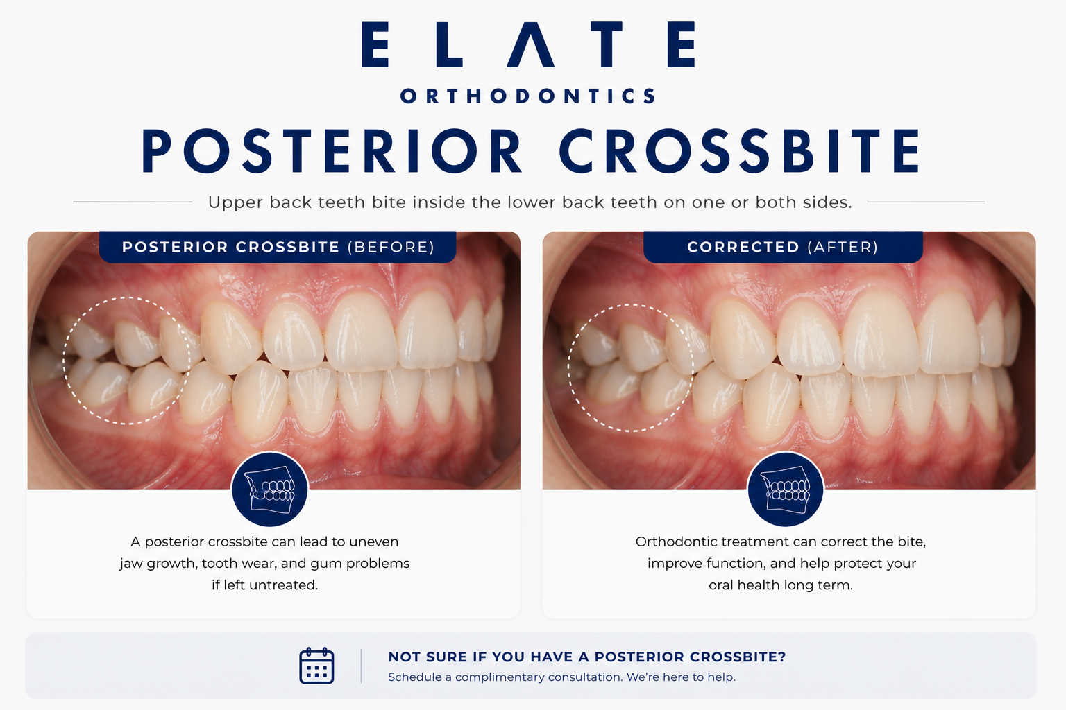 Posterior crossbite correction at Elate Orthodontics in Frisco and The Colony TX with palatal expander braces and clear aligners