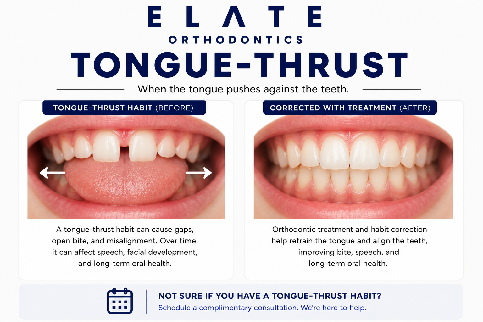 Tongue thrust treatment at Elate Orthodontics in Frisco and The Colony TX with habit appliances and myofunctional therapy