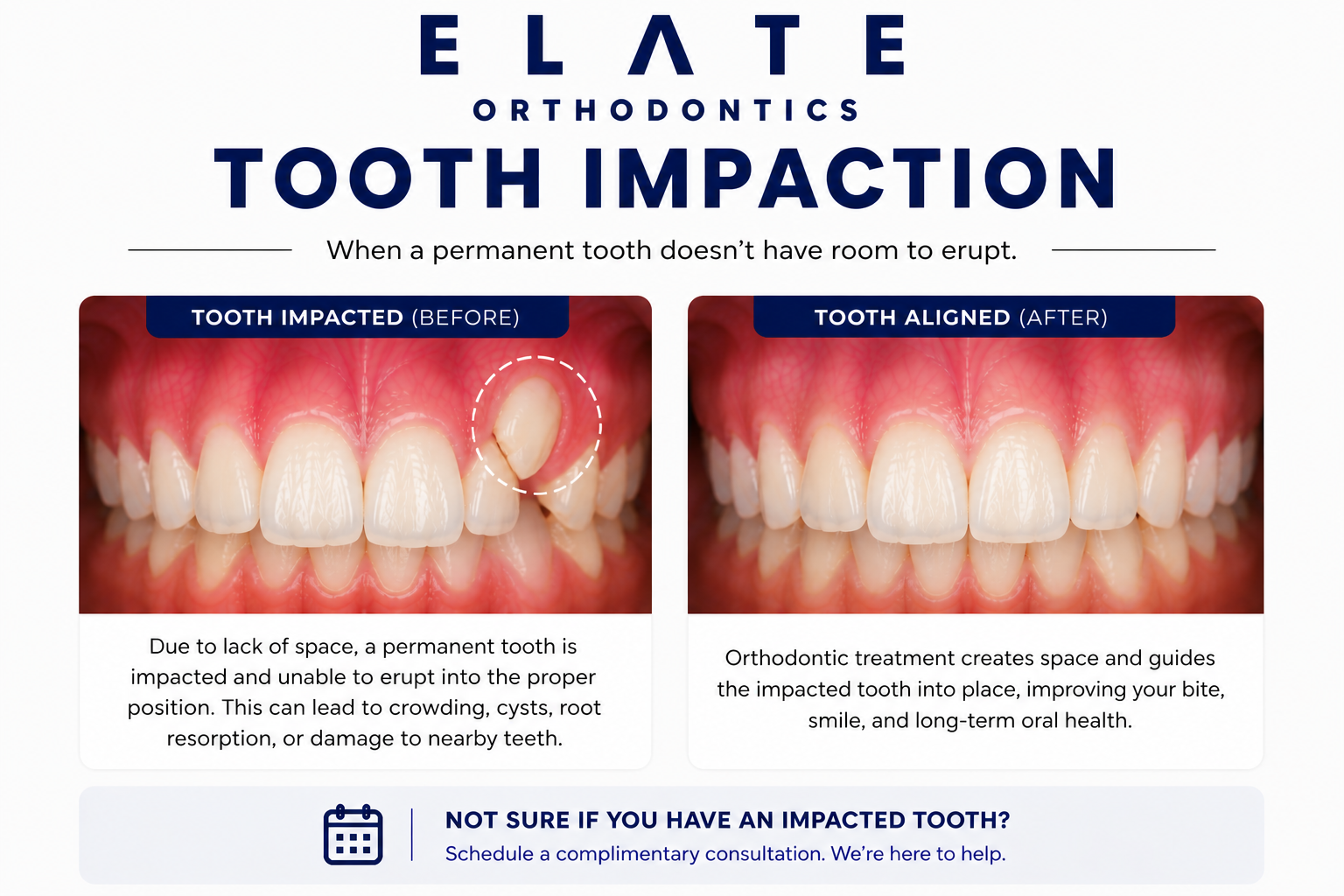 Impacted tooth treatment at Elate Orthodontics in Frisco and The Colony TX with surgical exposure and orthodontic traction