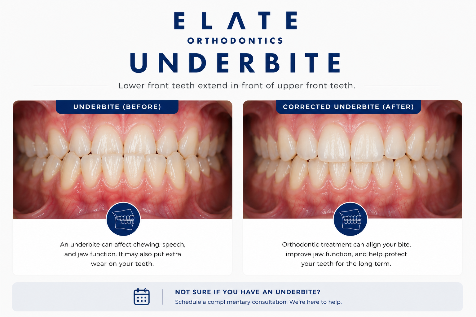Underbite correction at Elate Orthodontics in Frisco and The Colony TX with early intervention reverse-pull headgear braces and clear aligners