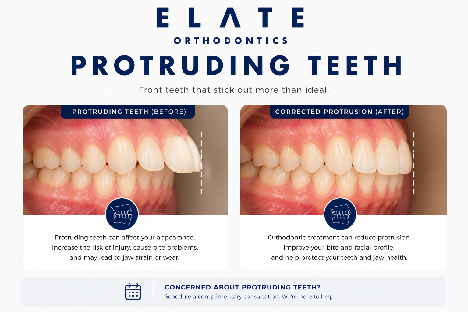 Protruding teeth correction at Elate Orthodontics in Frisco and The Colony TX with braces clear aligners and growth modification